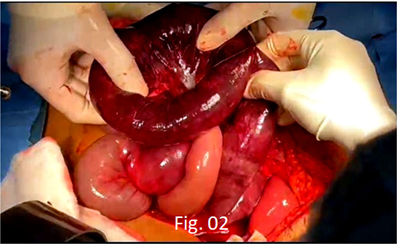 Figure 2: Intraoperative Finding Depicting the Extent of Gross Gangrene Involving the Jejunum with Dense Adhesions involving the Mesentry and A Kink in the Intestinal Loop(Lead Point).