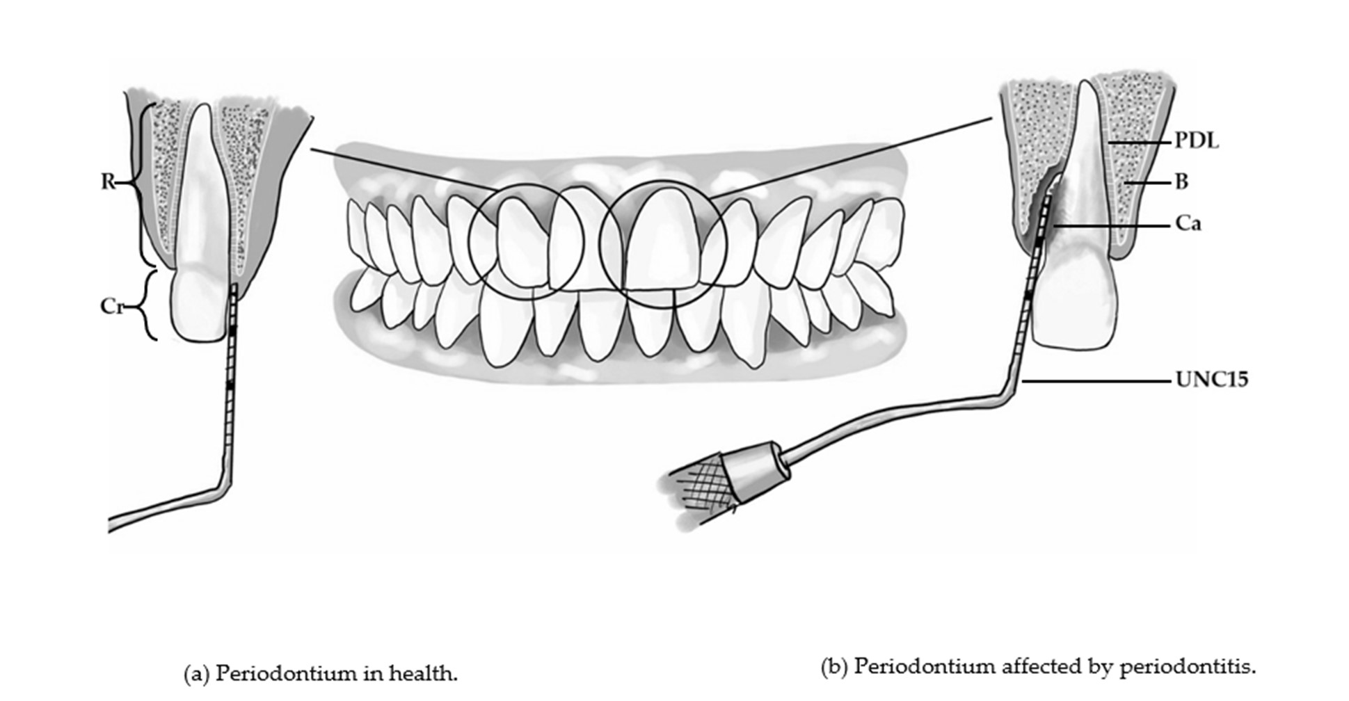 Figure 1: The estimated percentage of the global population afflicted by the disease varies depending on severity. For severe cases, a report previously estimated that 11.2% of the global population was affected [2]. When all presentations of periodontitis are included, a prevalence close to 50% could be found [3]. Furthermore, the literature suggests that there is an association between periodontitis and adverse health outcomes like premature death, diabetes and cardiovascular disease [1].