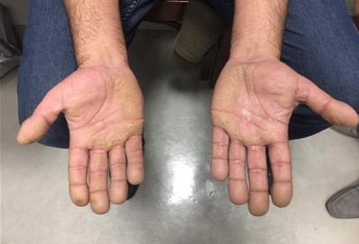 Figure 1: Keratoderma over the palms with hyperhidrosis and notable digital clubbing. A 4 mm punch biopsy was taken from the patient’s left palm, which revealed hyperkeratosis, hypergranulosis, mild epidermal hyperplasia, and sparse superficial perivascular lymphocytic infiltrate consistent with keratoderma (Figure 2). Systemic work-up for any cardio- pulmonary disease and malignancy was non-revealing.