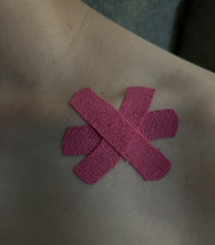 Figure 12: Photobiomodulation applied after sutures dissolved.