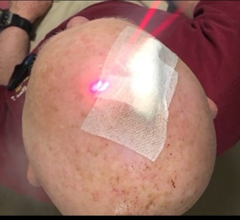 Figure 3: Note the immediate effects of vocal vibration therapy using a weighted ohm tuning fork to increase circulation postoperatively, thus reducing pain.