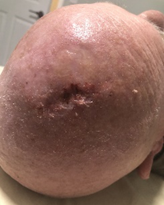 Figure 5: Photobiomodulation in the subacute phase to reduce edema and stimulate collagen.