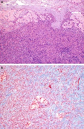 Figure 2: Stromal hyperplasia with hyperthecosis delineating spindled shaped cells commingled with scanty collagen fibrils. Foci of luteinized, polygonal theca cells appear impregnated with eosinophilic cytoplasm.