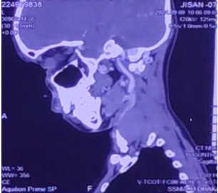 Figure 2: CT Scan Film.