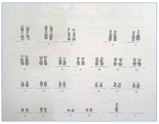 Figure 1: Karyotyping 45XO.