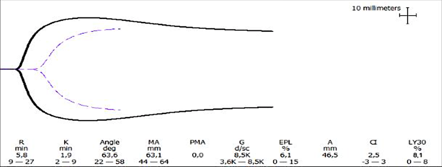 Figure 1: Clinical example of primary hyperfibrinolysis on TEG. Note: D-Dimer – 950 µg/l.