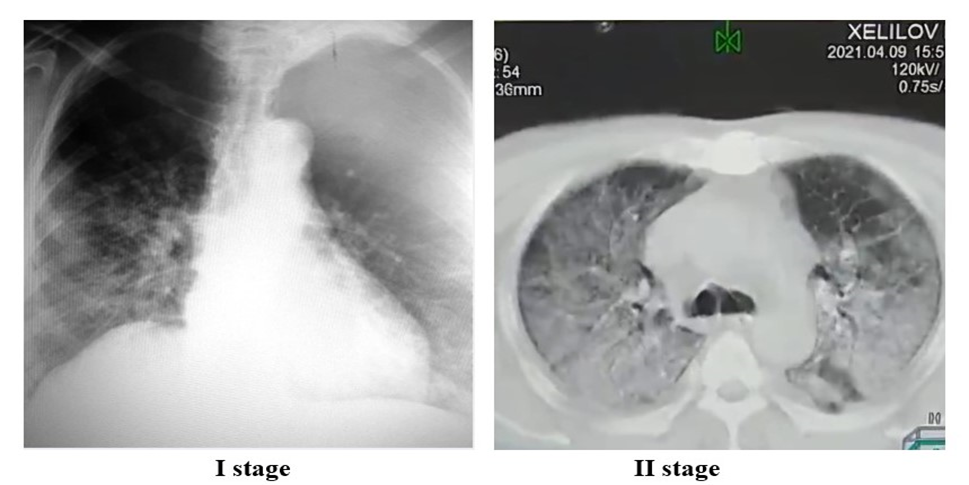 Figure 4: Radiological pattern of ARDS stage I and II.