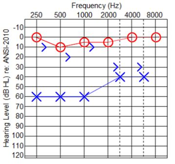Figure 1: Pure tone audiometry. Left ear conductive hearing loss.