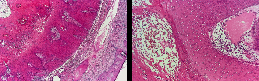 Figure 3: Histology demonstrating an acanthotic epidermis with abrupt trichilemmal keratinization. The cyst lumen contained dense eosinophilic material, without atypia (hematoxylin–eosin (HE)).