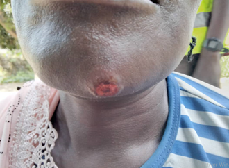 Figure 1: Calabash Wound.