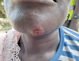 Figure 1: Cutaneous leishmaniasis under the chin of a patient in Birao.