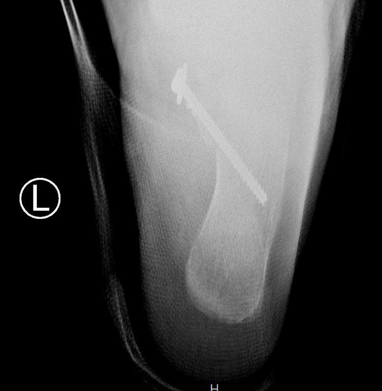Figure 3: Harris view x-ray post operative.