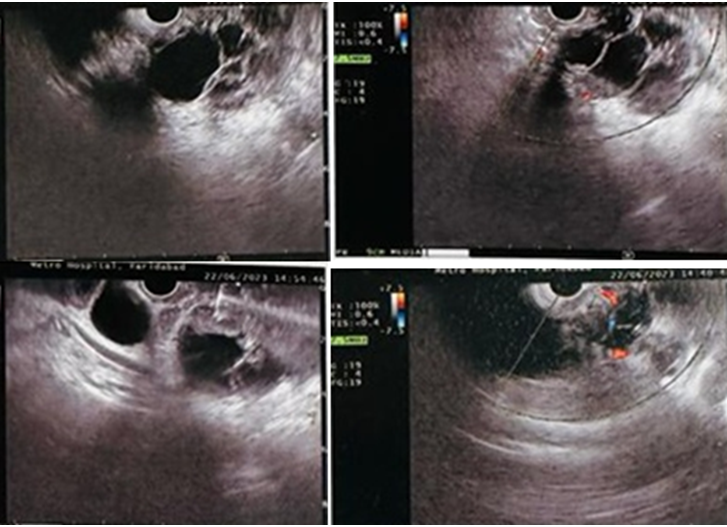 Figure 1: Endoscopic Ultrasound Findings and Fine Needle Aspiration Report.