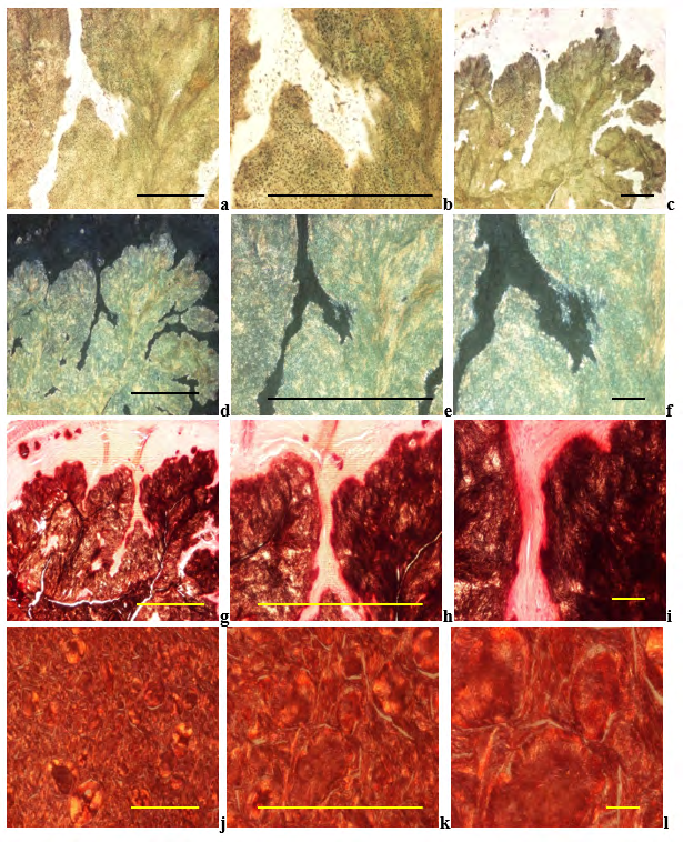 Figure 2: Gouty arthritis (tophaceous gout), MSU [NaC5H3N4O3·H2O] – monosodium salt of uric acid [C5H4N4O3] crystal deposits, surrounded by fibrous connective tissue, without remarkable inflammatory reaction.
