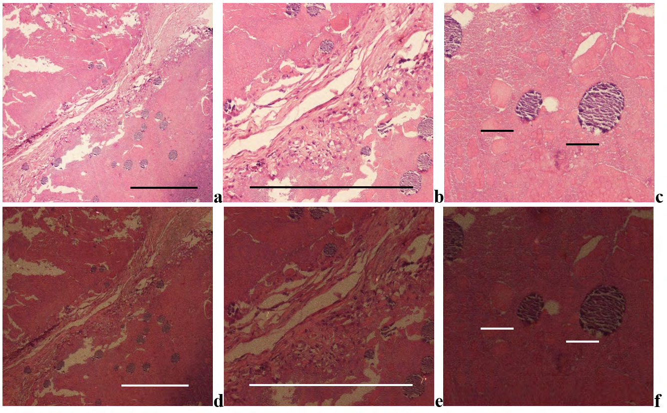 Figure 3: Hydroxyapatite arthropathy (Milwaukee syndrome, apatite rheumatism) induced by hydroxyapatite [Ca5(PO4)3(OH)] (HA) accompanied with amorphous calcium phosphate [Ca3(PO4)2] and/or calcium carbonate [CaCO3] deposits.