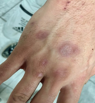 Figure 2: Lesions on the Hand of Case 2.