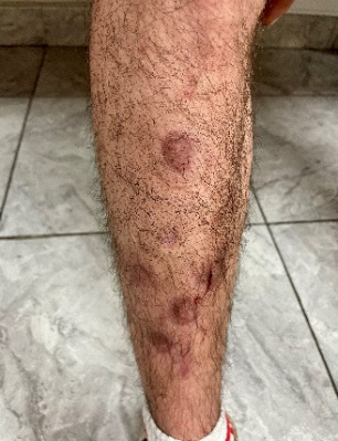 Figure 3: Lesions on the Right Knee of Case 2.