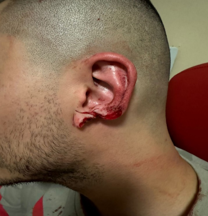 Figure 1: Ear after the incident.