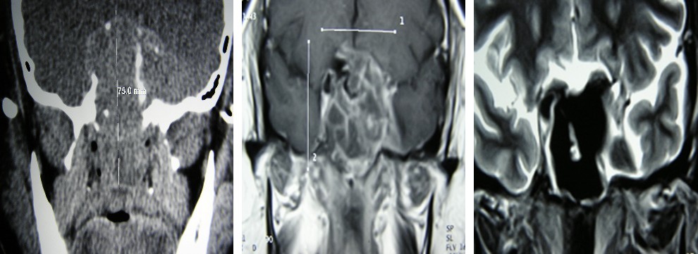 Figure 3: Synchronous squamous cell carcinoma with inverted papilloma T4-B.