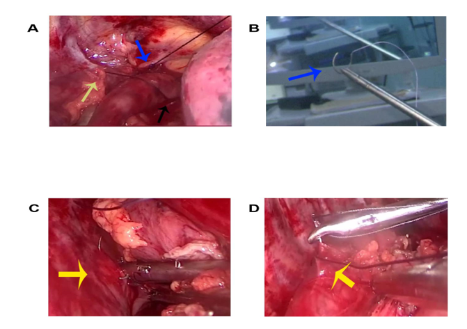 Figure 1: A: Schematic representation of the “8-needle” suspension suture technique demonstrating the three-point suspension strategy for gastric fundus fixation. Blue arrow: First suture penetrating the cupula of pleura; Yellow arrow: Second suture anchoring the muscular layer of gastric lesser curvature; Black arrow: Third suture securing the greater curvature musculature. This triangular suspension configuration effectively reduces anastomotic tension, narrows the gastric reservoir, and reconstructs the His angle through high-pressure zone formation. B: Intraoperative demonstration of the fishhook-shaped configuration achieved by the second suspension suture in the three- point fixation system. C: Initial placement of the second suspension suture at the paravertebral region, showing fixation between the costal periosteum and pleural membrane. D: Detailed view of the second suspension suture application, illustrating precise muscular layer engagement at the gastric flexural aspect.