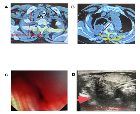 Figure 3: A. Red arrow indicates the sternal end of the right clavicle; yellow arrow shows the esophagogastric anastomosis located superior to the clavicle on postoperative CT. B. Yellow arrow marks the diameter of the non-divided tubular gastric conduit measured on postoperative CT. C. Endoscopic findings (February 19, 2025) reveal esophageal stenosis at 16 cm from the incisors, with extrinsic compression contributing to luminal narrowing. D. Ultrasonography demonstrates lymphadenopathy posterior to the right thyroid gland.