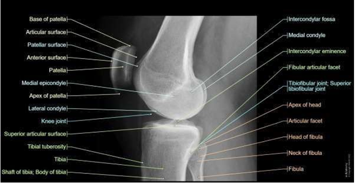 Figure 3: ** Lateral radiographic view of Right Knee.