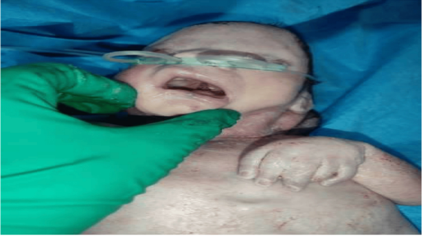 Figure 1: Retrognatism and posterior cleft palate.