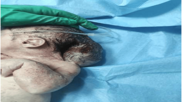 Figure 2: Occipital encephalocele.