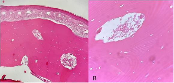 Figure 2: Stratified squamous epithelium of mature bone trabecular with fibrous stroma A B (Credit-Science Direct).