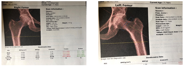 Figure 2: Signs of Osteoporosis in Right Femur & Left Femur.