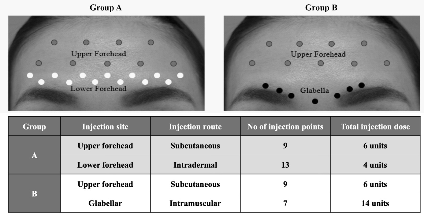 Figure 1: Botulinum toxin A (BTA) injection sites in the forehead and glabellar areas of patients in groups A and B. The upper and lower forehead regions were separated by a horizontal line drawn 2 cm above the eyebrows. In group A, BTA was injected subcutaneously into 9 points (total 6 units) in the upper forehead area and intradermally into 13 points (total 4 units) in the lower forehead area. In group B, BTA was injected subcutaneously into 9 points (total 6 units) in the upper forehead area and intramuscularly into 7 points (total 14 units) in the glabellar complex.