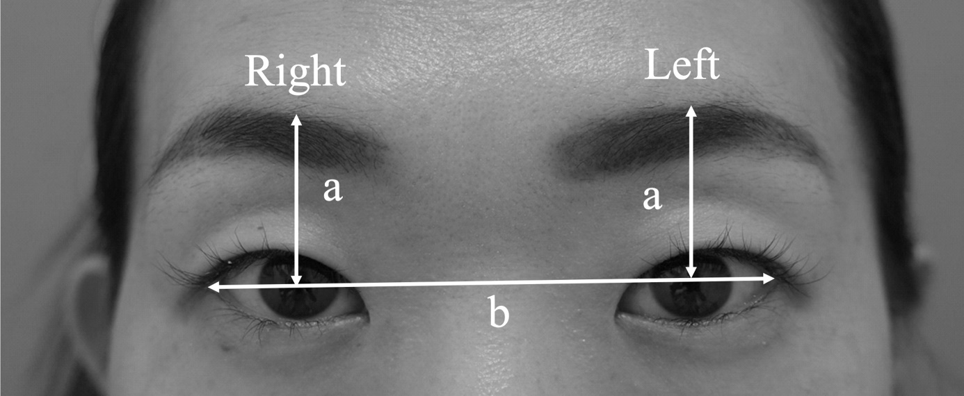 Figure 3: Measurement of eyebrow height. Line b indicates the horizontal line between bilateral lateral canthus, and line a indicates the mid-pupillary lines from line b to the upper edge of the brow. The eyebrow heights and balance of both sides were calculated using formulas (1) and (2).