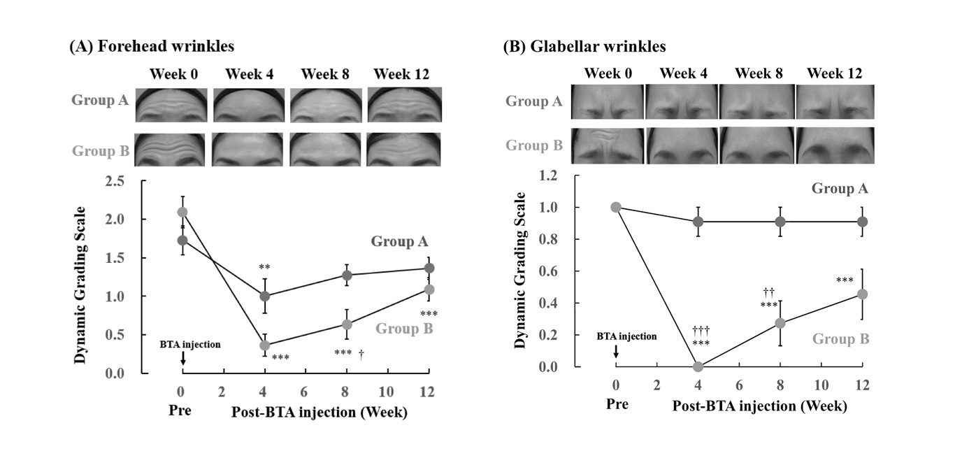 Figure 5: Changes in the severity of forehead (A) and glabellar wrinkles (B) after BTA injection in groups A and B. The photos show the dynamic wrinkle status of the patient’s forehead and glabellar before (week 0) and after BTA injection (weeks 4, 8, and 12) in groups A and B. Wrinkle severity was graded into five levels from 0 to 4. Each value represents the mean ± SEM (n = 11). **P < 0.01 and ***P < 0.001 vs. pretreatment week 0 (two-way ANOVA + Tukey’s multiple comparison test). †P < 0.05, ††P < 0.01, and †††P < 0.001 vs. group A (two-way ANOVA + Mann–Whitney U test).