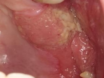 Figure 1: Upper Left Gingiva.
