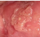 Figure 2: Ulcers in Cheek.