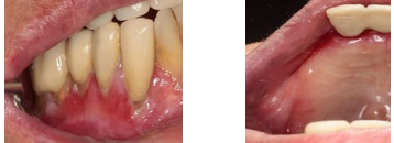 Figure 4: Erythrolein Lesion in Lower and up Vestibule.