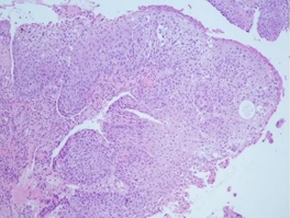 Figure 6: Squamous Cell Carcinoma of Oral Mucosa.