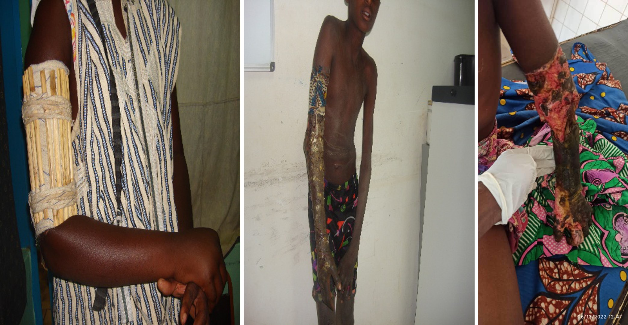 Figure 1: shows: A: a traditional splint B: an application C and D: complications.