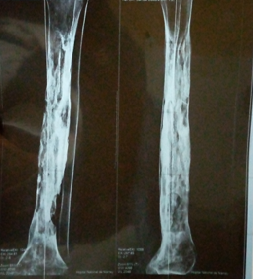 Figure 2: Chronic Osteomyelitis of the Leg.