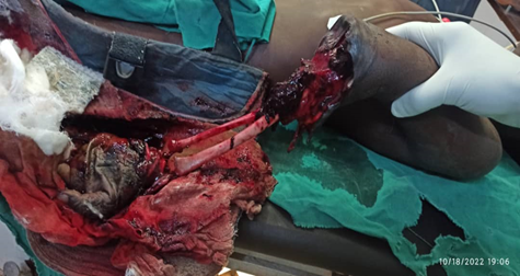 Figure 3: Gangrene of the upper limb in a 14-year-old patient following traditional immobilization.