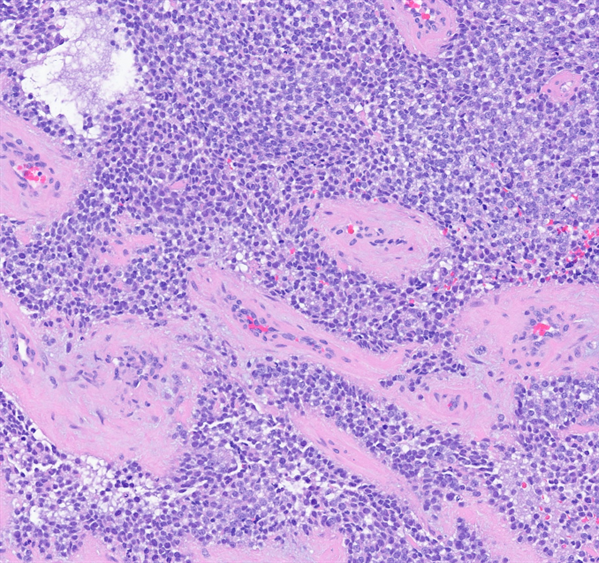 Figure 1: Sheets of small round blue cells with clear to eosinophilic cytoplasm are present with thickened vessels (H&E, 20X).