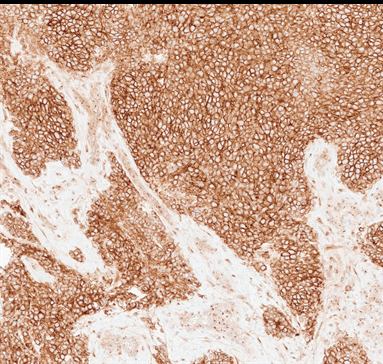 Figure 2: Tumor cells are positive for CD99 immunohistochemical stain (20X).