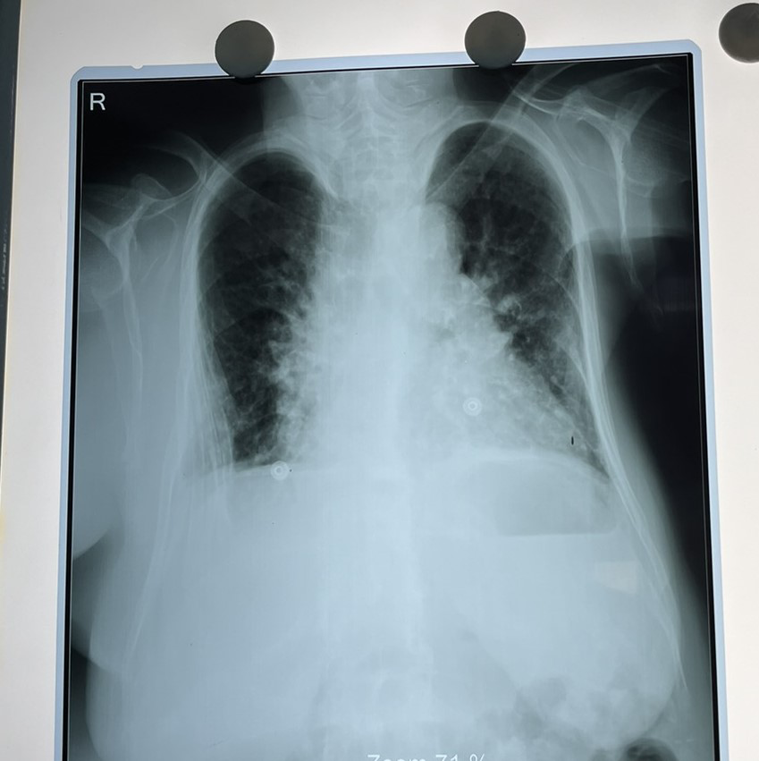 Figure 2: Hyperinflated lung fields with hyperkyphosis of thoracic vertebrae.