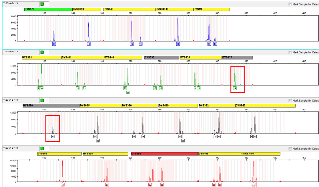Figure 5: The Electropherogram Showing Allele Drop Out in 1:3 (A:B) Input DNA Ratios of Male DNA (Case Study Sample) and Control DNA 2800M, (A- Male DNA (Case Study Sample), B- Control DNA 2800M).