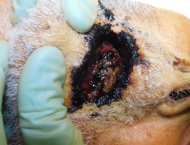 Figure 3: The Mouth was Completely Covered with Blood Clots and Crusts, Both Internally and Externally.