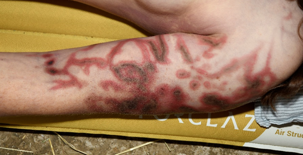 Figure 2: Skin Lesions on the Left Upper Arm at the Scene.