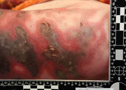 Figure 3: Skin Lesions on the Upper Left Arm at Autopsy.