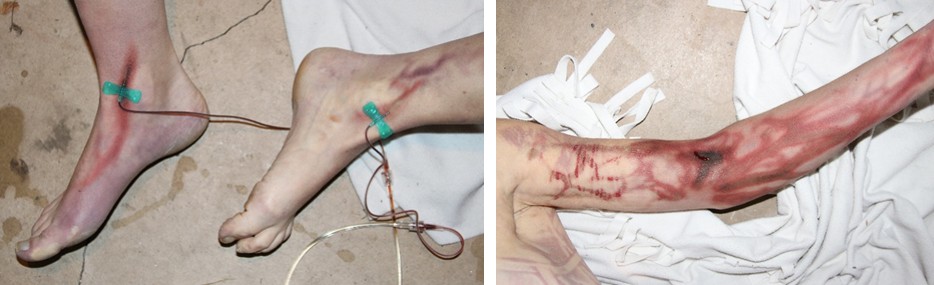 Figure 5: Skin Lesions Around Infusion Sites in a Case of Suicidal Intoxication with Pentobarbital.