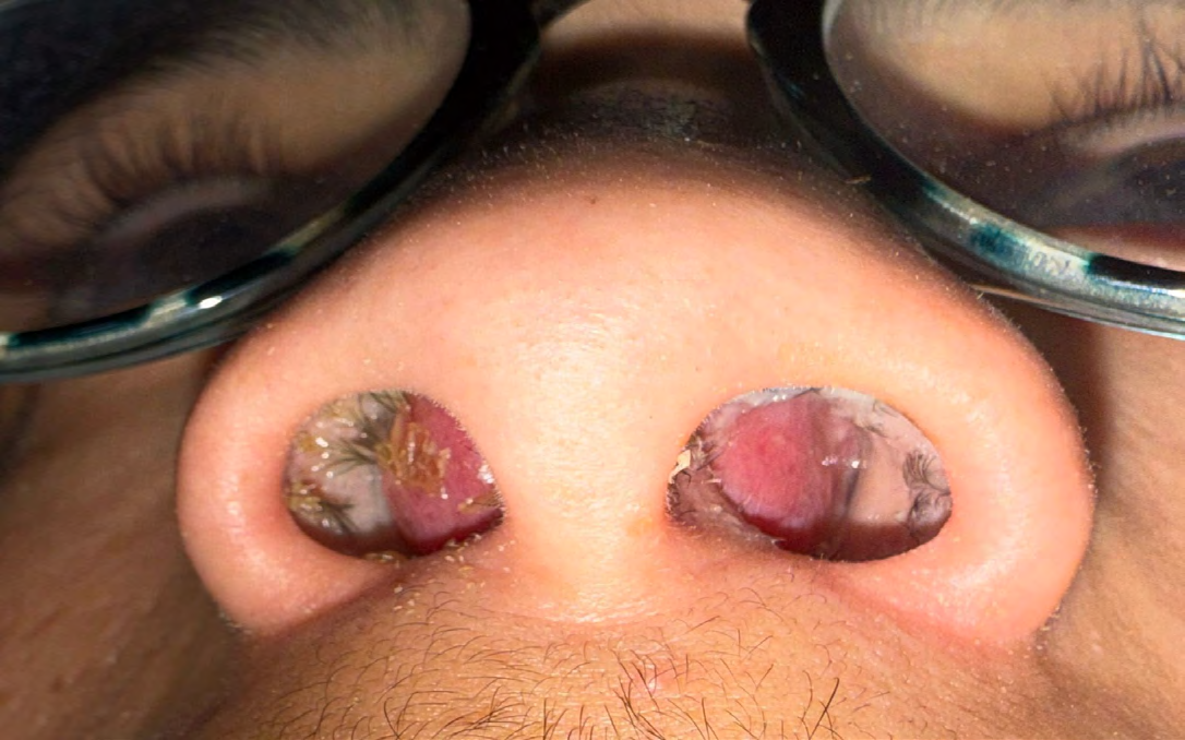 Figure 1: Bilateral Swelling of the Nasal Septum Obstructing the Nasal Cavities.
