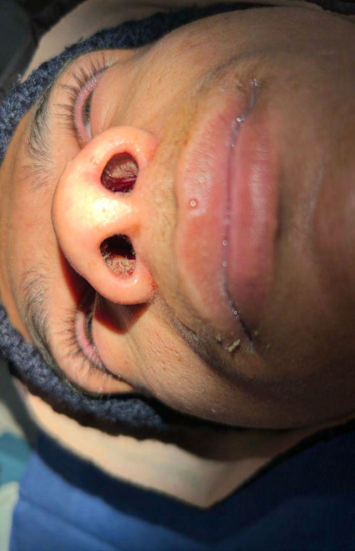 Figure 2: Clinical Improvement Observed 48 Hours After the Abscess Drainage Puncture.